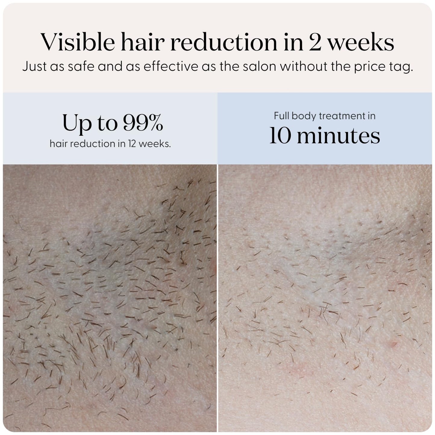 SmoothSkin Pure Fit IPL, visible results in 2 weeks, safe full body use