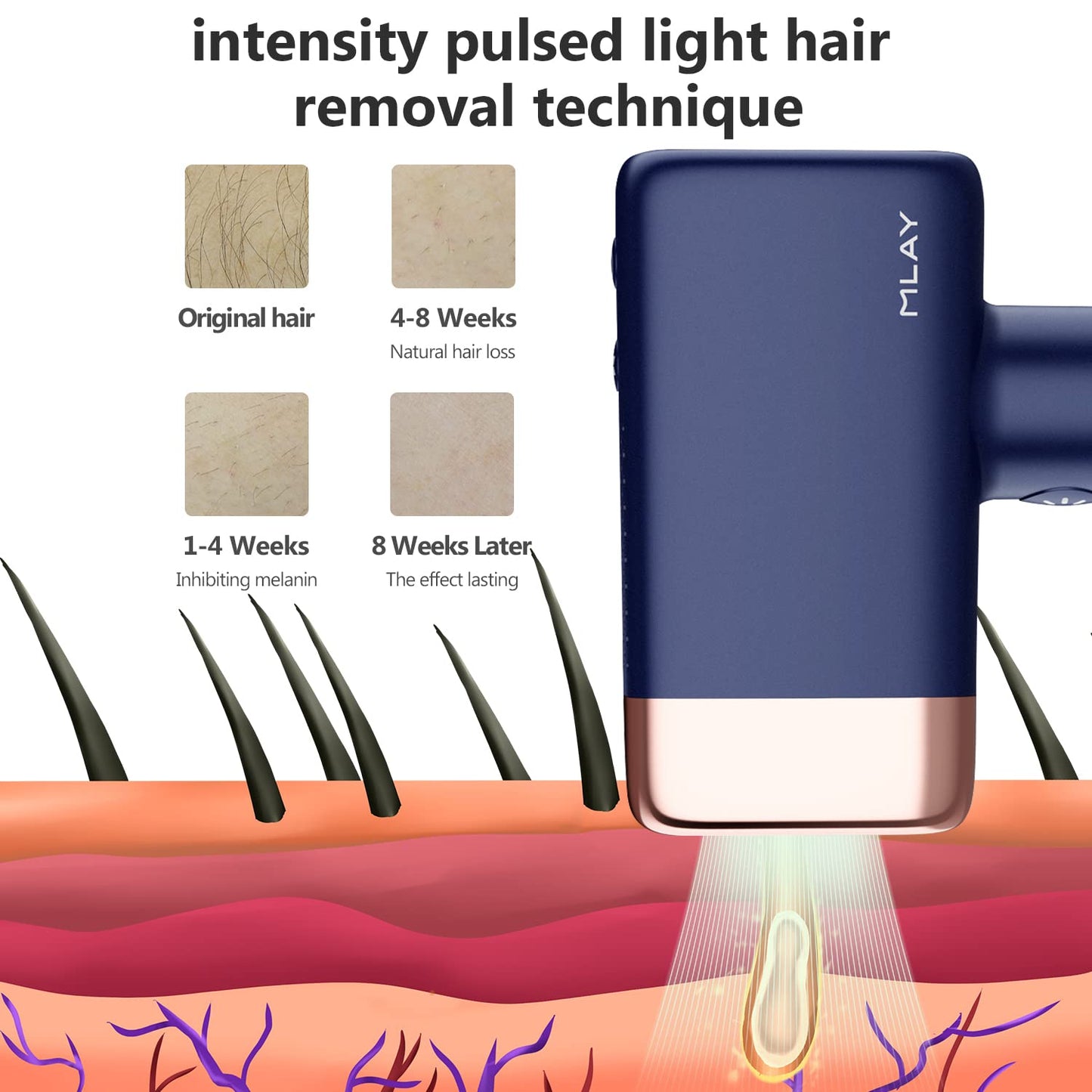 MLAY IPL device, ice-cooling, full body hair remover kit