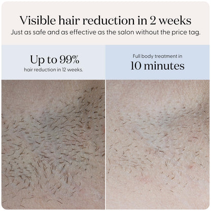 SmoothSkin Pure Fit IPL, visible results in 2 weeks, safe full body use